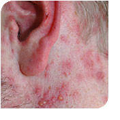 herpetic rash pictures #11